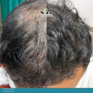 Hair growth doesn’t happen overnight—but with the right diagnosis, consistent treatment, and a littl