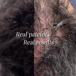 ✨ Hair Loss Transformation | Case by Dr. Rohit Gupta ✨
Swipe to see the incredible transformation ac
