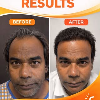 ✨ DHI Hair Transplant Results ✨
From thinning hair to a fuller, natural-looking hairline 💯

This am