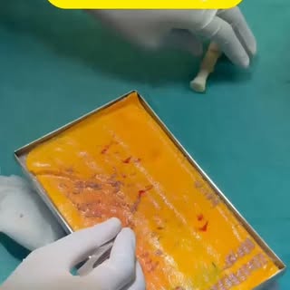 DHI technique (Advanced version of FUE and Sapphire technique)