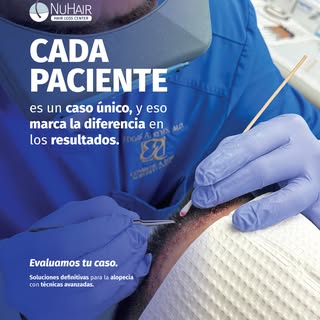 💇🏽‍♀️ No todas las caídas de cabello se comportan igual, y por eso no todas necesitan un trasplant
