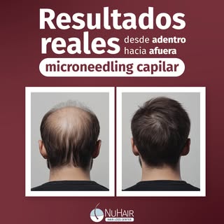 🌱 Si sientes que tu cabello ha perdido densidad o fuerza, no estás solo. Muchas personas llegan con
