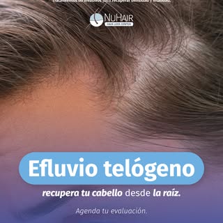 💇🏽 Cada paciente llega con una historia distinta: estrés, cambios hormonales, genética… y nosotros