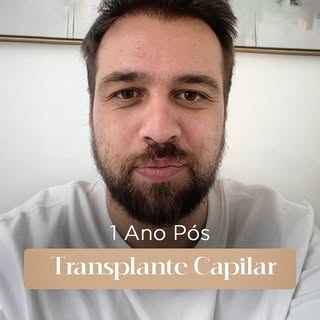 ✨ Esse é o resultado do nosso querido paciente, após 1 ano do transplante capilar. Cabelos mais chei