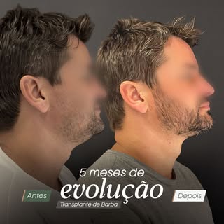 Cada fio faz parte de uma transformação construída com técnica, planejamento e paciência. Após 5 mes