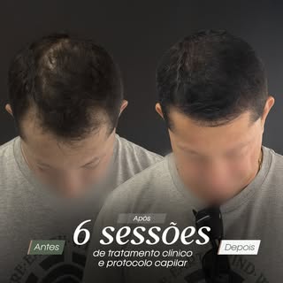Após 6 sessões de tratamento clínico associadas ao protocolo capilar personalizado, já é possível ob