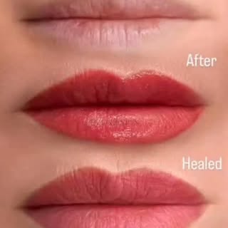 Lip Augmentation #cosmeticsurgery #botox #skincare #plasticsurgery #skin
