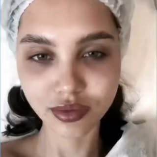 Salmon DNA  #filler #botox #foryou #laser #undereyedarkness #skin #skincareroutine #brazil