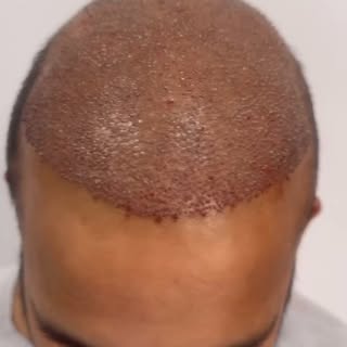 #Hair  #HairTransplant #skincare # skin #laser #fillers #botox #CosmeticSurgery