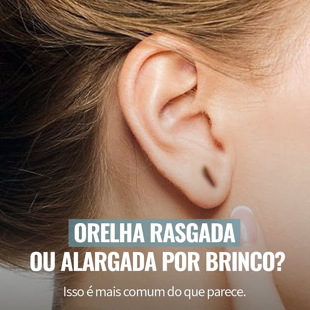 Você já deixou de usar um brinco que gosta por causa do lóbulo rasgado ou alargado?

Esse é um incôm