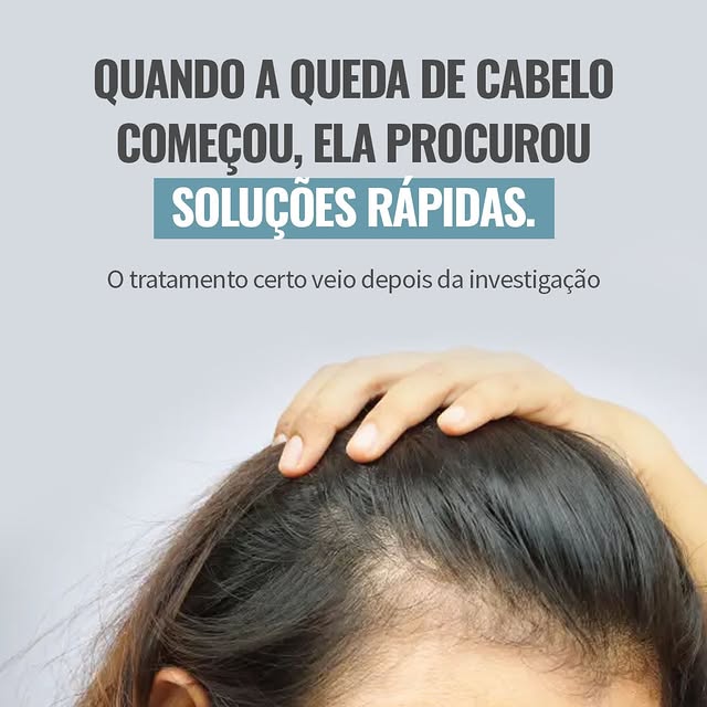 A queda de cabelo feminina é uma queixa comum, mas nem sempre tem a mesma origem. 

Ela pode estar r