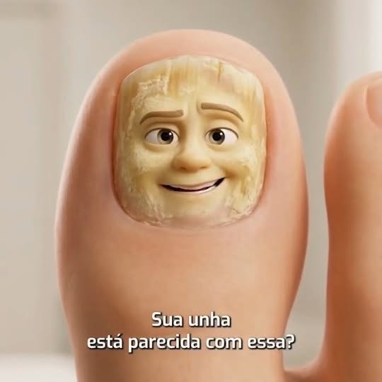 Unha grossa, amarelada ou descolando pode ser micose — e quanto antes tratar, melhores os resultados