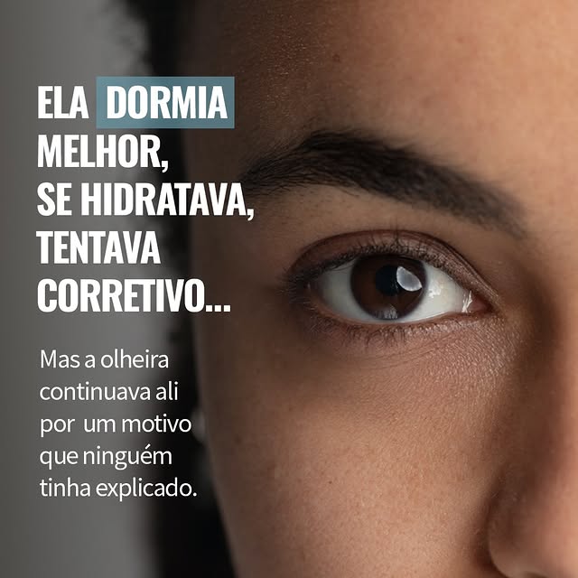 As olheiras não são todas iguais, e esse é um ponto essencial para entender por que alguns tratament