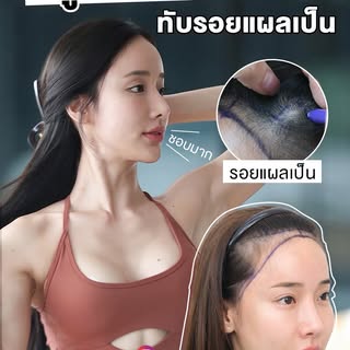 💬 รอยสักแฮร์ไลน์...ไม่จำเป็นต้องอยู่กับคุณตลอดไป
หากแฮร์ไลน์ที่เคยสักไว้ดูแข็ง ไม่เป็นธรรมชาติ หรือ