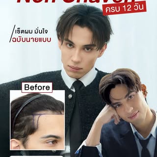 กรอบหน้าหล่อขึ้นแบบนายแบบ **ด้วยปลูกผมสั้นแบบไม่โกน Non-Shaven FUE ครบ 12 วัน** เปลี่ยนแนวผมถอยให้กล