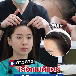 🇱🇦 สาวลาวเลือกบินมาไทย เพื่อปลูกผมกับ MediHair!
ปัญหามุมผมเว้า หน้าผากกว้าง หรือแนวผมไม่สมดุล สามา