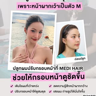 ถ่ายรูปทีไรต้องหามุมหลบ…
เพราะหน้าผากเว้าเป็นตัว M ใช่ไหม?  หลายคนคิดว่าเป็นแค่ปัญหาทรงผม แต่จริง ๆ 