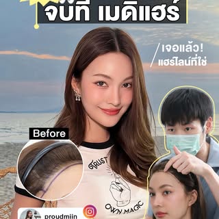 ปลูกมา 2 ครั้งยังไม่จบ รอบนี้จบ! ที่ MediHair💚
ปลูกผมแบบยาว ปรับกรอบหน้าใหม่ เนียนเป็นธรรมชาติ กรอบ