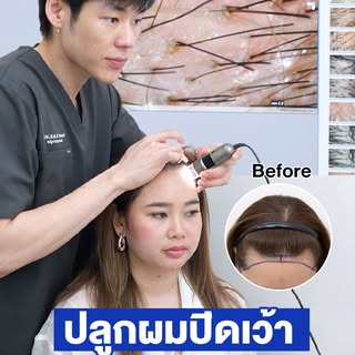 **14 วันหลังปลูก จาก "มุมผมเว้า" สู่ "มุมว้าว"**
✨ เติมกรอบหน้าด้วย Non-Shaven FUE เทคนิคปลูกผมแบบไม