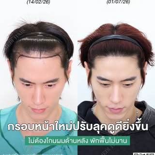 Review…เคสคุณผู้ชายมีปัญหาแนวไรผมด้านหน้าค่อนข้างสูง ทำให้หน้าผากดูกว้าง กรอบหน้าไม่ชัด  หลังปลูกผมป
