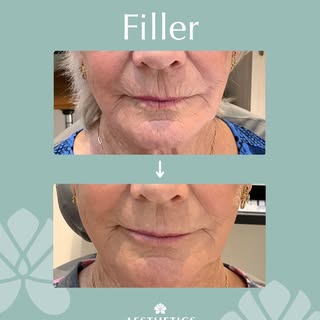 Before and after improvement around the mouth! 💯

This 76-year-old female was noticing wrinkles aro