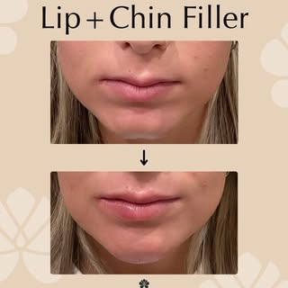 Before & after: lip and chin filler edition 💋

A small amount of filler in the lips and chin can ma
