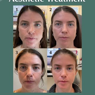 The “win-win” transformation with TMJ Botox 🙌

This TMJ Botox treatment is a “win-win” in aesthetic