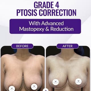 💜✨ Restore Shape. Restore Comfort. Restore Confidence. ✨💜

Breast sagging (ptosis) can occur due t