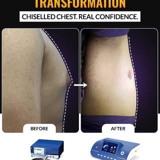 🔥 Confidence Restored. Chest Redefined. 🔥

Gynecomastia is more than just excess chest fat—it ofte