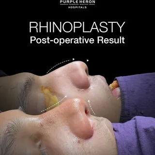 👃✨ Every successful rhinoplasty is measured by more than just appearance—it’s about achieving harmo