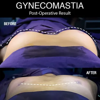 💪✨ Confidence begins with feeling comfortable in your own skin.

Gynecomastia is more than a cosmet