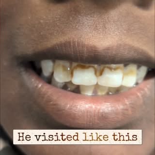 ✨ Say Goodbye to Tooth Stains & Hello to a Brighter Smile! 🦷✨

Coffee, tea, smoking, and certain fo