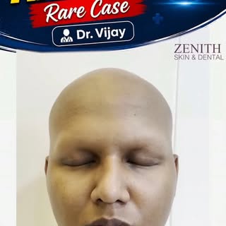 Complete alopecia treatment, 
Worry less get early treatment 
9643212127 #skindoctor #hairtreatment 