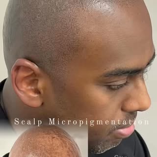 What a transformation for this client! Absolutely stunning work 🔥🔥 by @josaldini 

#SMP #scalpmicr