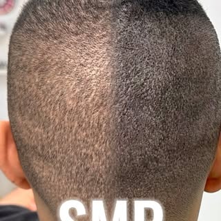 SMP density can dramatically improve the appearance of an FUE donor scar by blending it seamlessly w