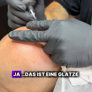 Glatze ist nicht gleich Glatze 👨🏽‍🦲

Mit SMP wird aus einer kahlen Glatze ein gepflegter, klarer 