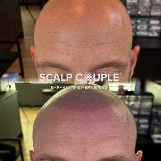 🔥 Von einer ungleichmäßigen und kahlen Glatze zur definierten Haarlinie - die Power von SMP 💯

Ein