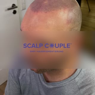 ☝🏼Eine Glatze macht dich nicht älter. Kahle und lichte Stellen, sowie eine ungepflegte und unförmig