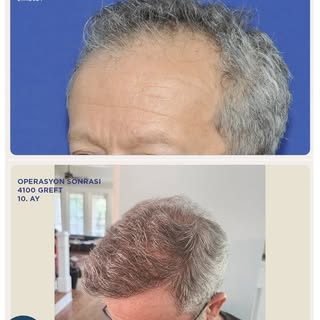 The most important and primary parameter determining the outcome of a hair transplant is the density