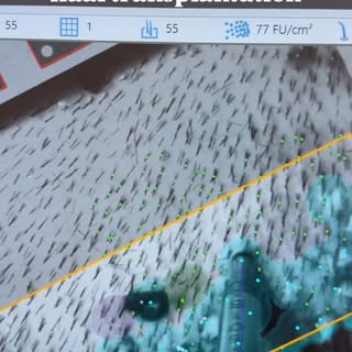 Mit der ARTAS® Technologie setzen wir auf höchste Präzision bei der Haarentnahme und eine besonders 
