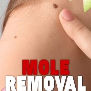 Thinking about removing a mole at home? ⚠️
Before trying random home remedies, know the right and sa