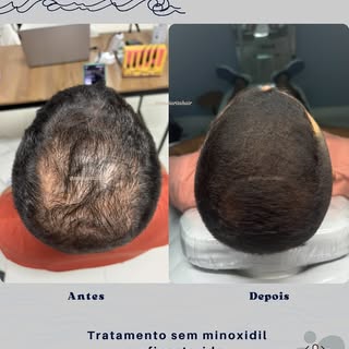 Seu shampoo NÃO vai fazer seu cabelo voltar a crescer.

Banho quente não causa calvície.
Mas pode au