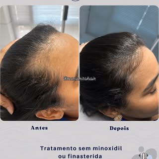 🚨 Se você anda de moto, seu capacete pode estar detonando seu cabelo sem você perceber.

E não, o p