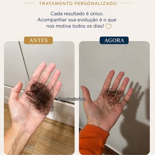 Seu cabelo está afinando e você acha que é normal?

Essa paciente chegou com uma alopecia androgenét