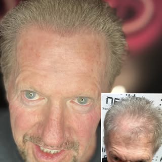 We offer the highest quality service possible! Scalp micropigmentation done with passion! Say goodby
