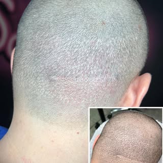 Follicle unit transplant scar camouflage. 
Immediately after 1st session.
Incredible instant results