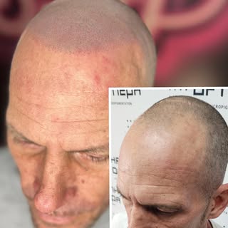 This client received his last treatment. He requested a natural hairline with a broken soft edge. He
