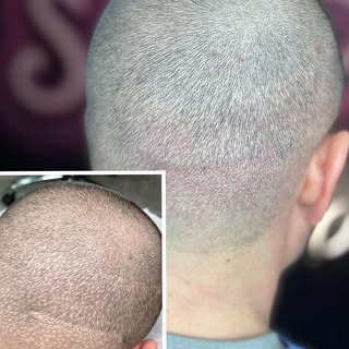 Follicle unit transplant scar camouflage.
If you suffer from any form of scaring, the good news is w