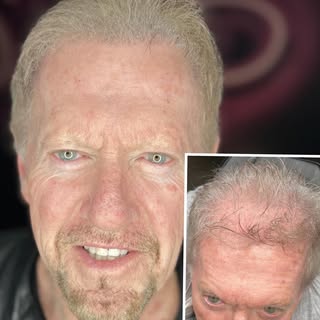 This was our final session. He was very excited with the coverage. If you suffer from hair loss and 