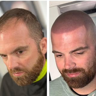 Life changing hair tattoo.
Reclaim you’re youthful appearance immediately, with scalp micropigmentat